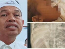 Dedi Mulyadi Murka: Balita Meninggal karena Cacingan