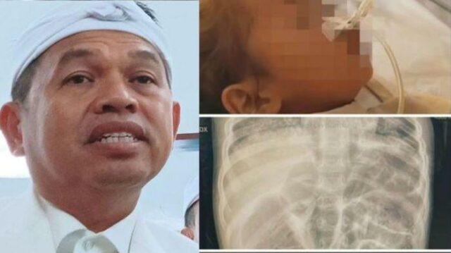 Dedi Mulyadi Murka: Balita Meninggal karena Cacingan